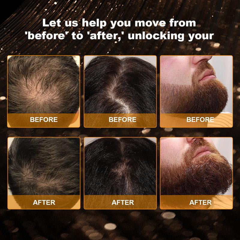 30Ml Minoxidil 5% – Just a Few Drops a Day for Fuller Hair or a Thicker Beard. Works for Both Men & Women!